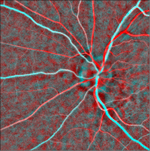 Example of retinal oximetry