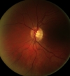 monocular fundus camera